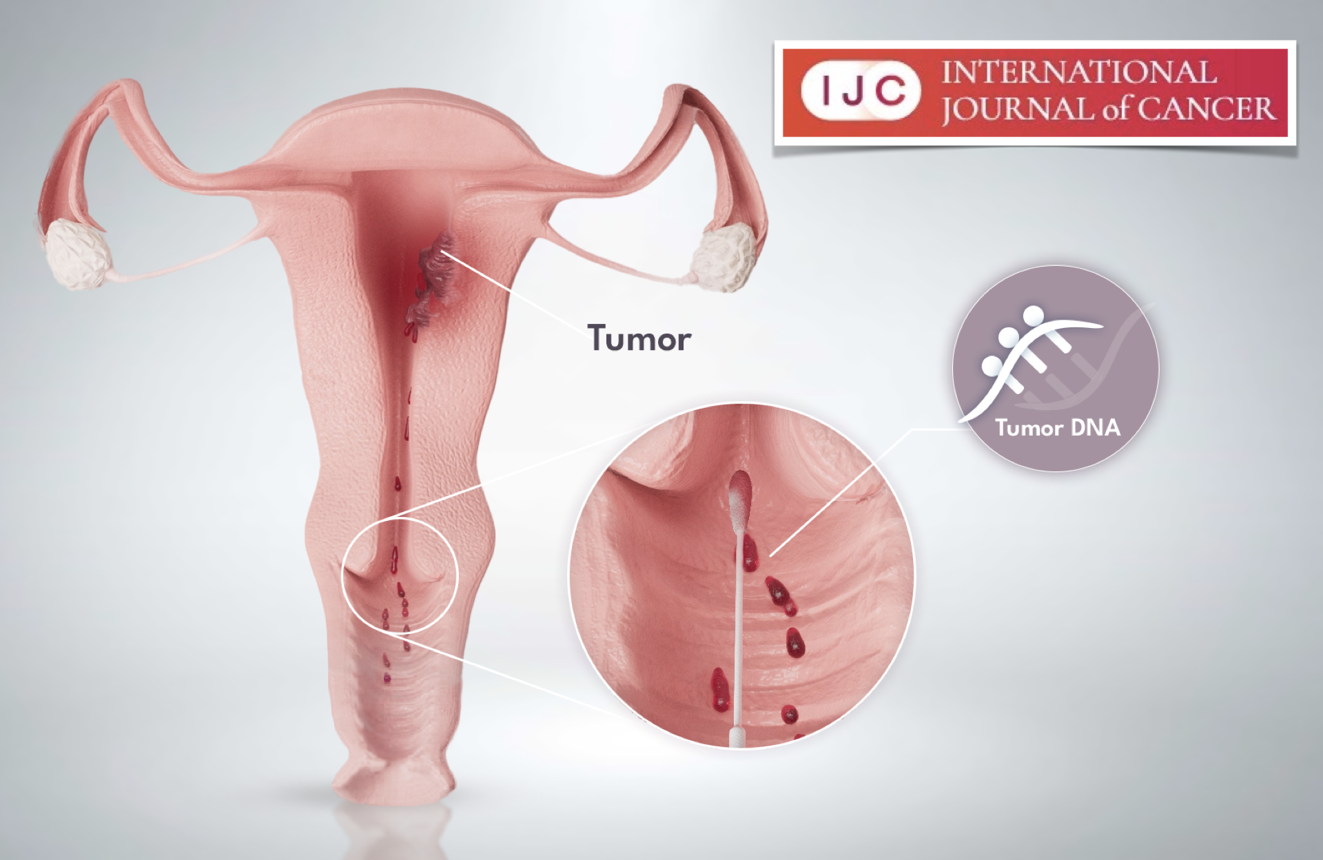 Image showcasing Real-life cohort and validation for cervical cancer - Sola